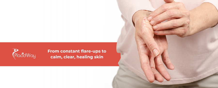 The End of Psoriasis Plaques? How Mexico’s Cutting-Edge Immune Therapies Are Drawing US Crowds