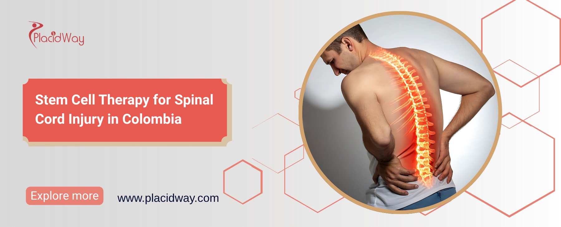 Terapia con células madre para la lesión medular en Colombia