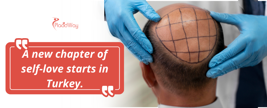 Hair Transplant in Turkey