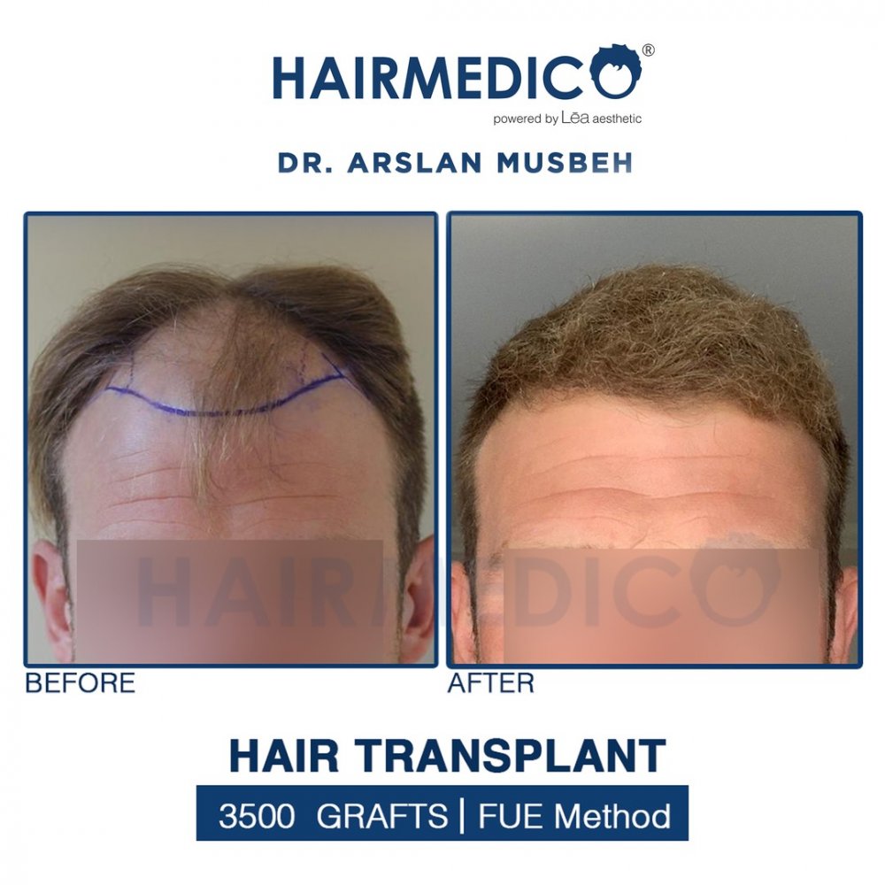 Hairmedico