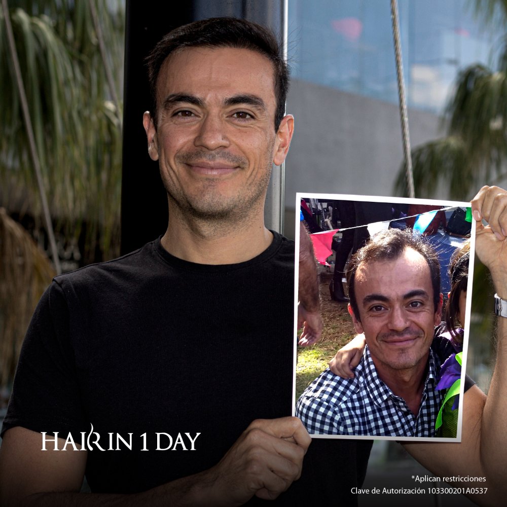 Hair in 1 Day - Hair Transplant Clinic in Guadalajara