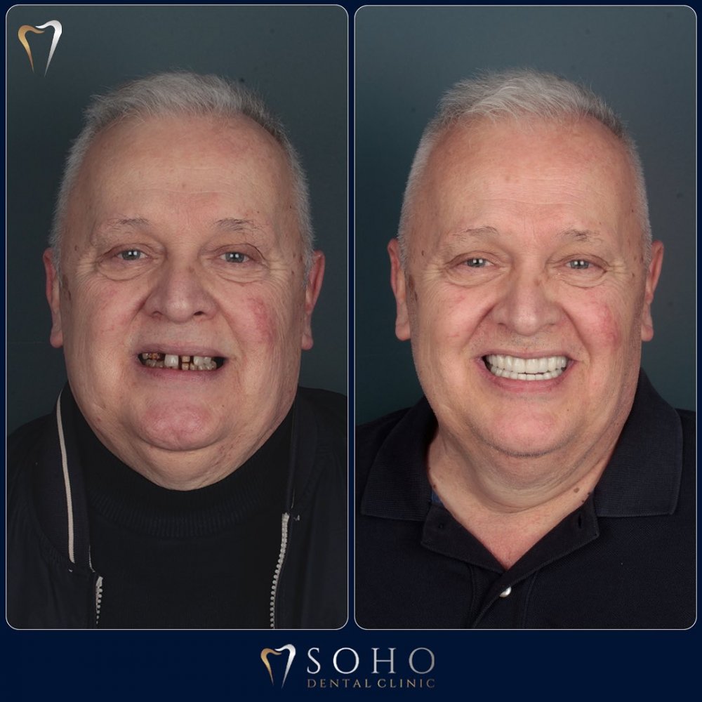 Soho Dental Clinic – All-on-X & Dental Implant Center