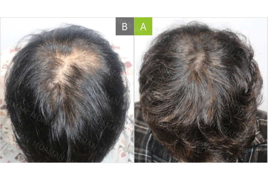 MOAMAN Hair Transplant Clinic