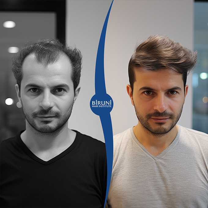 Biruni Hair Institute