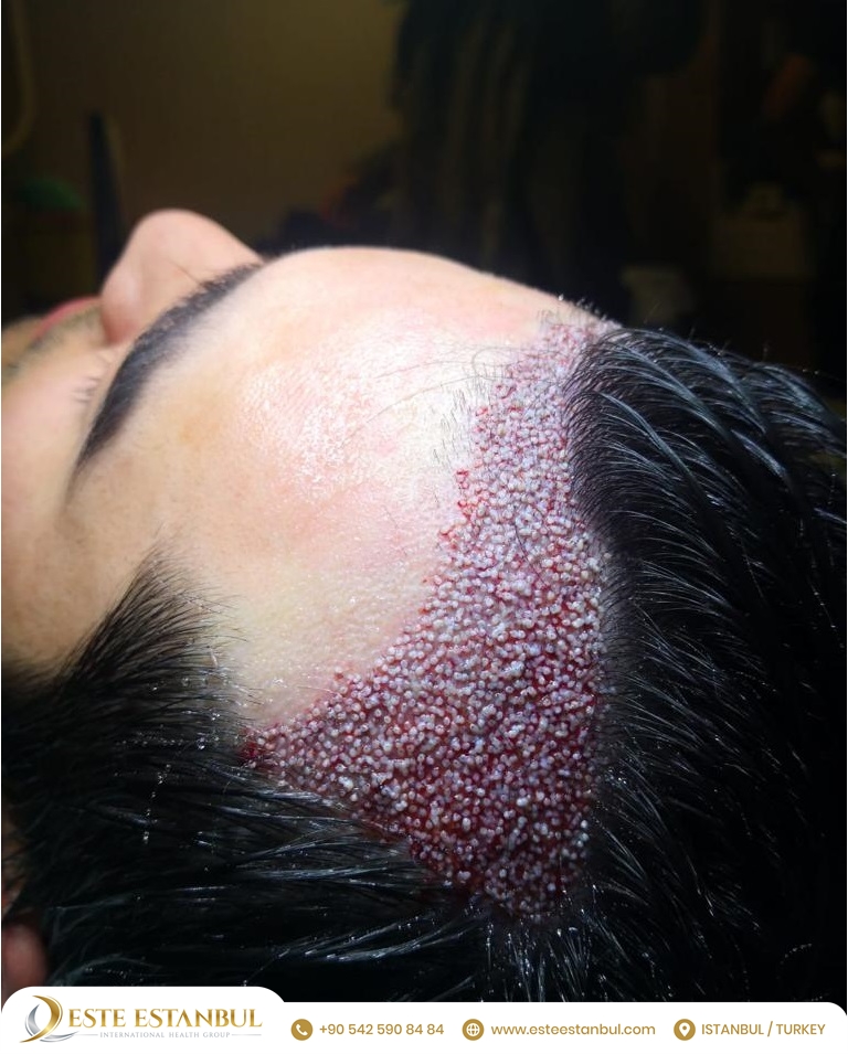 Este Estanbul - Hair Transplant Clinic Istanbul, Turkey